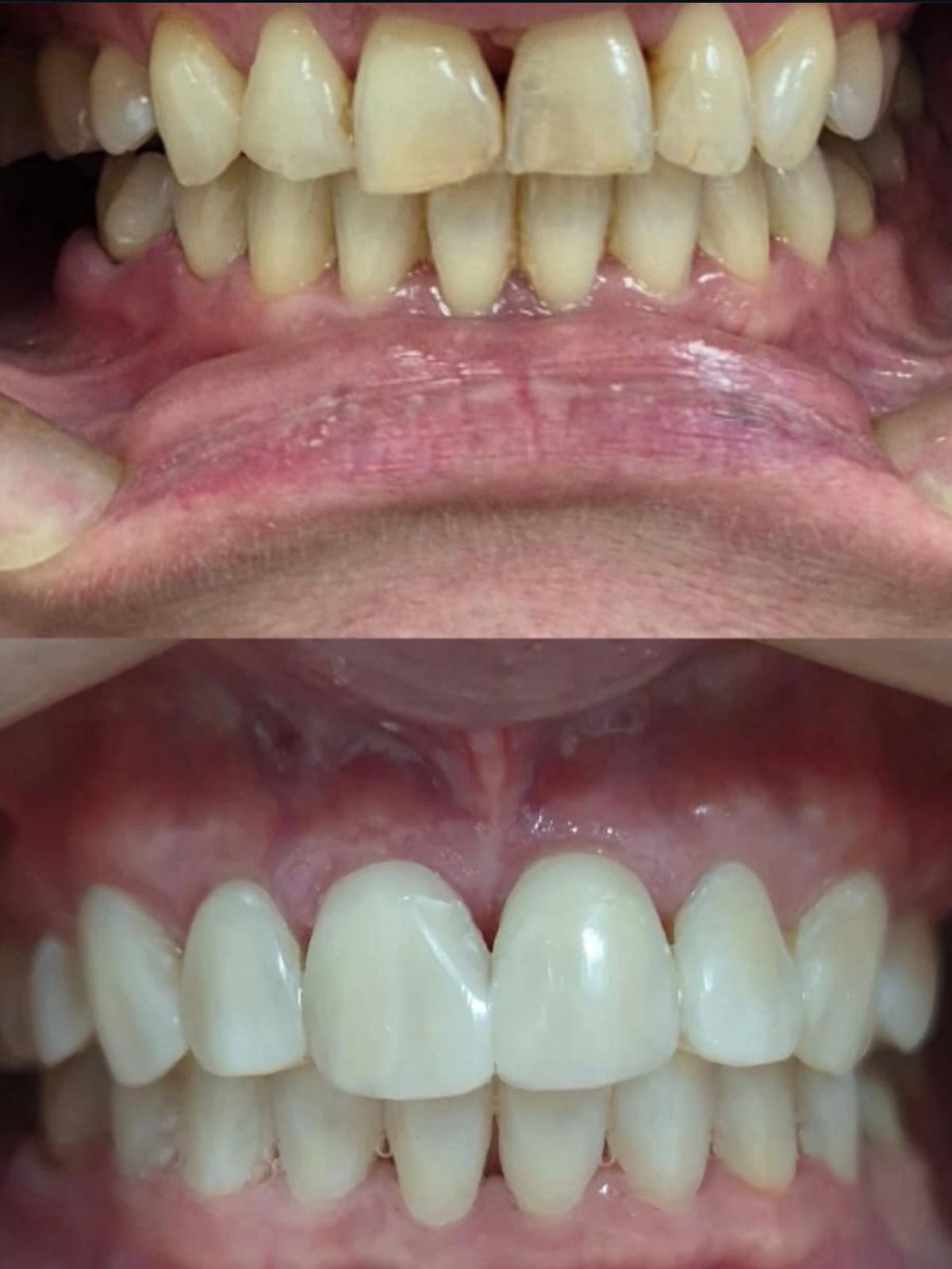 Clareamento Dental - Antes