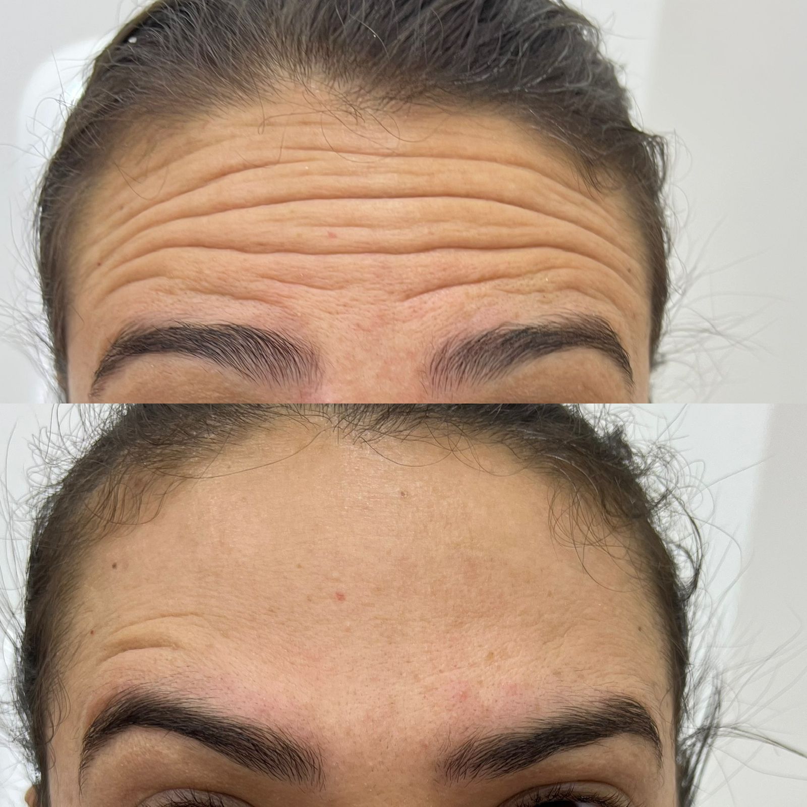 Harmonização Facial - Resultado