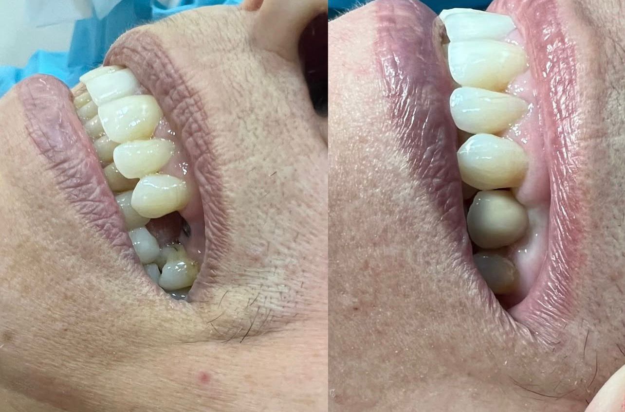 Implante Dentário - Resultado